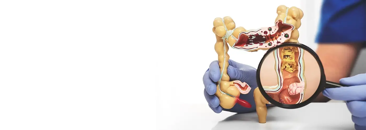 How Colorectal Cancer is Diagnosed How to Diagnose Colorectal Cancer